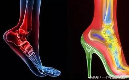 跟骨痛的康复训练方法,跟骨痛的封闭疗法