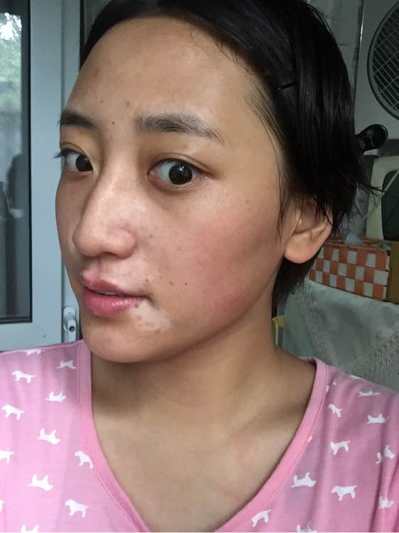 白斑光照,白斑光照后图片