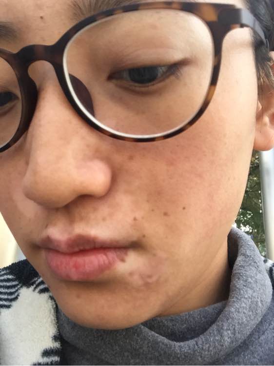 白斑光照,白斑光照后图片