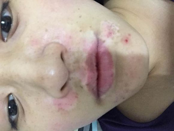 白斑光照,白斑光照后图片