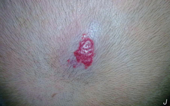 婴幼儿血管瘤会自己消除吗,血管瘤属于恶性肿瘤还是良性肿瘤