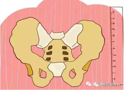 孕晚期骨盆测量一般怎么去测量,孕期骨盆如何测量