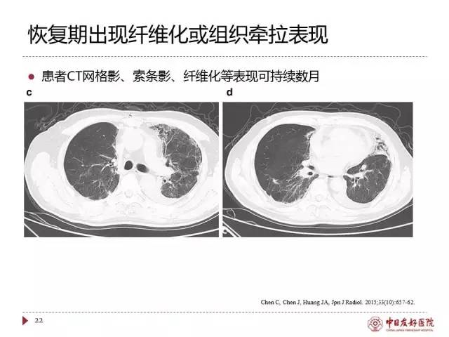 「规范与指南」人感染H7N9禽流感诊疗方案（2017年第一版）