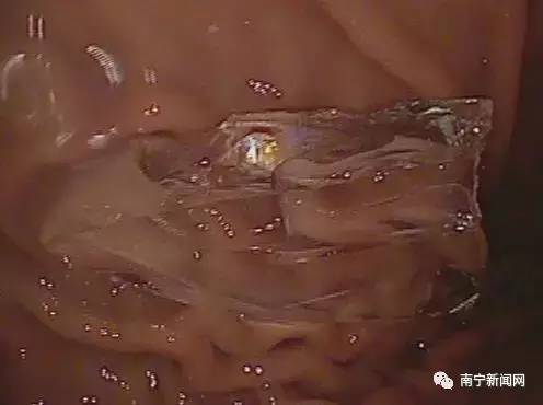 惊呆｜南宁一女孩怒吞玻璃，竟然是因为……