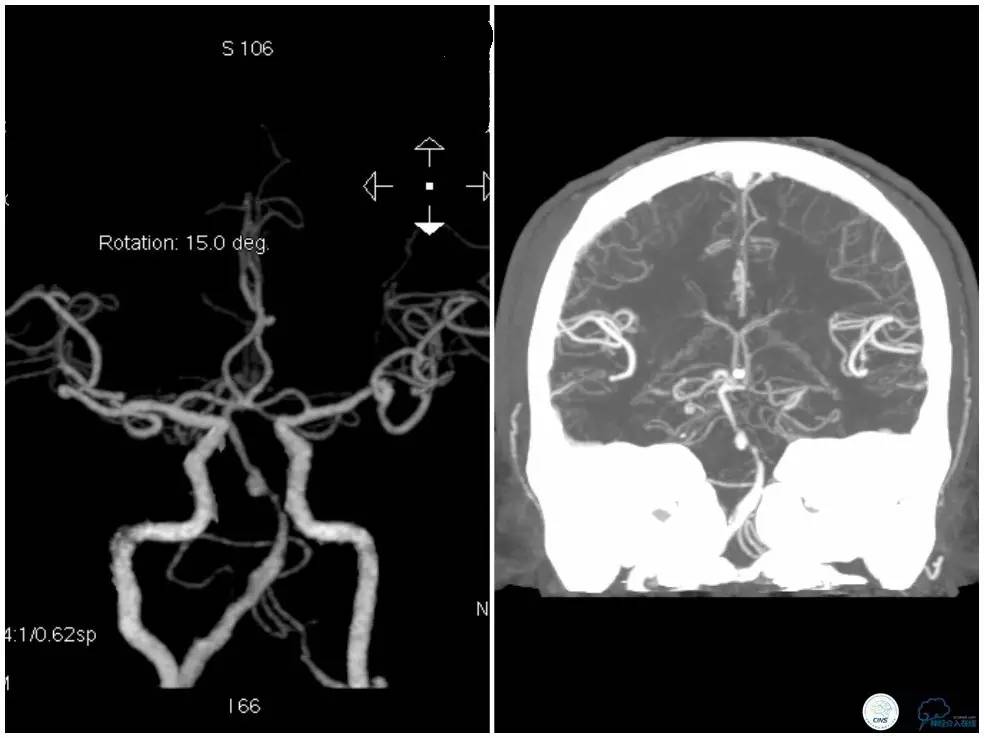 天坛周记｜基底动脉狭窄合并动脉瘤血管内介入治疗一例