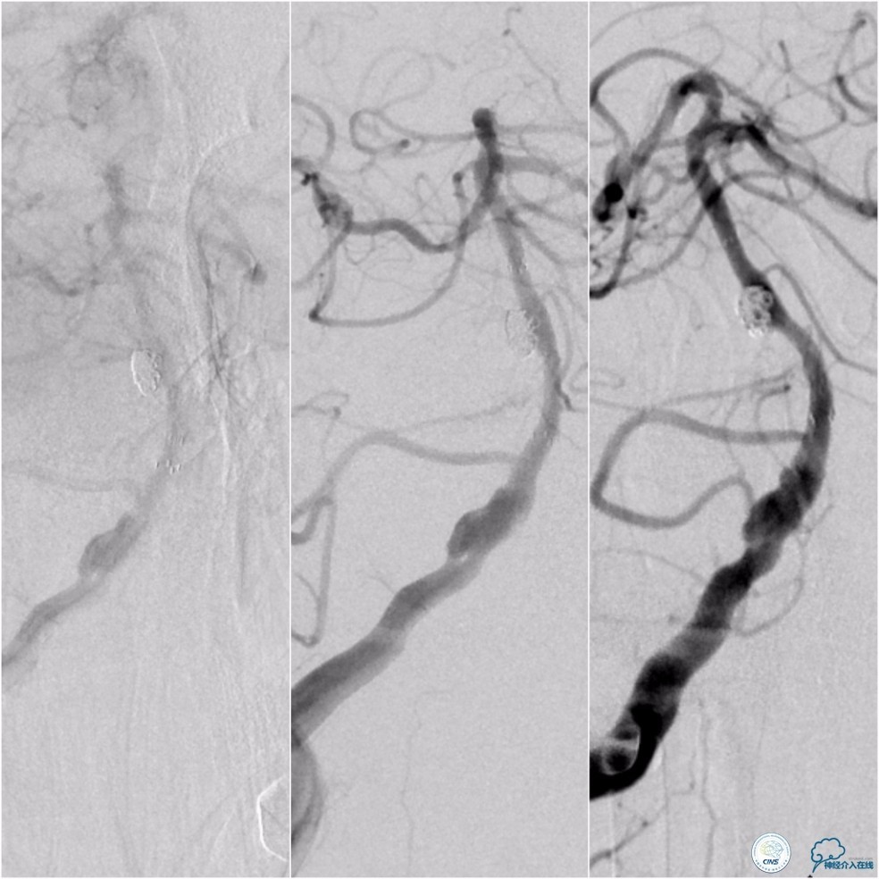 天坛周记｜基底动脉狭窄合并动脉瘤血管内介入治疗一例
