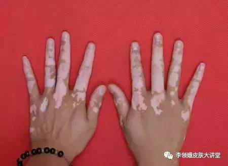 白癜风的鉴别诊断,白癜风的鉴别诊断有哪些