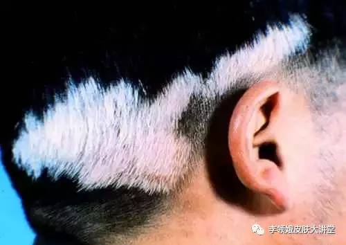 白癜风的鉴别诊断,白癜风的鉴别诊断有哪些