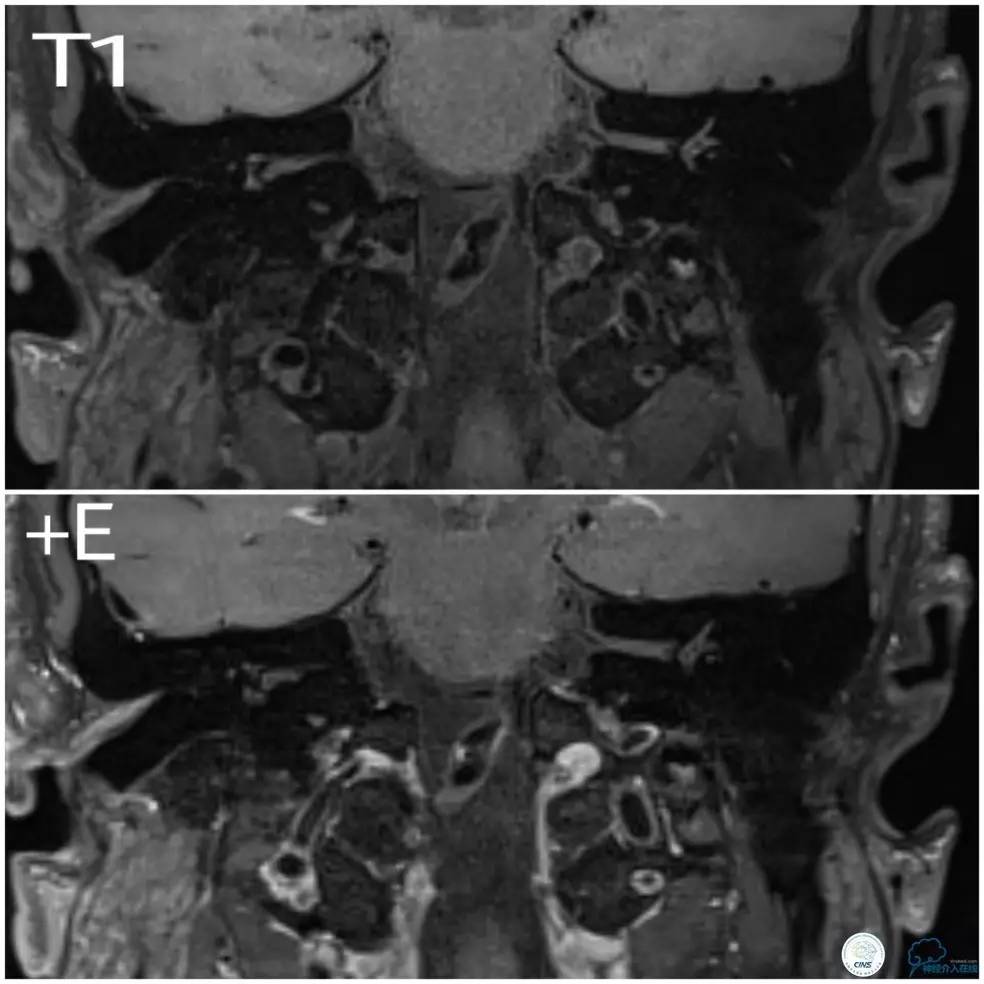 天坛周记｜基底动脉狭窄合并动脉瘤血管内介入治疗一例
