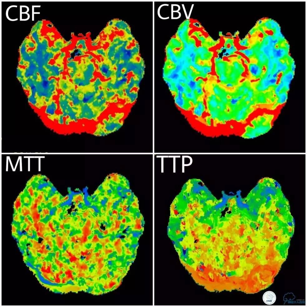 天坛周记｜基底动脉狭窄合并动脉瘤血管内介入治疗一例