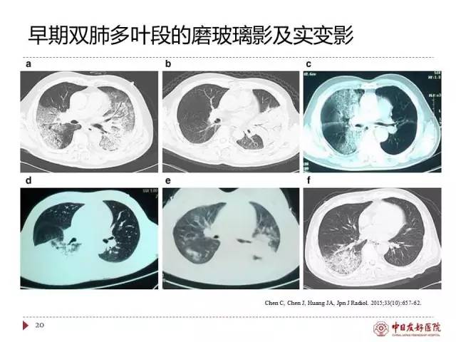 「规范与指南」人感染H7N9禽流感诊疗方案（2017年第一版）