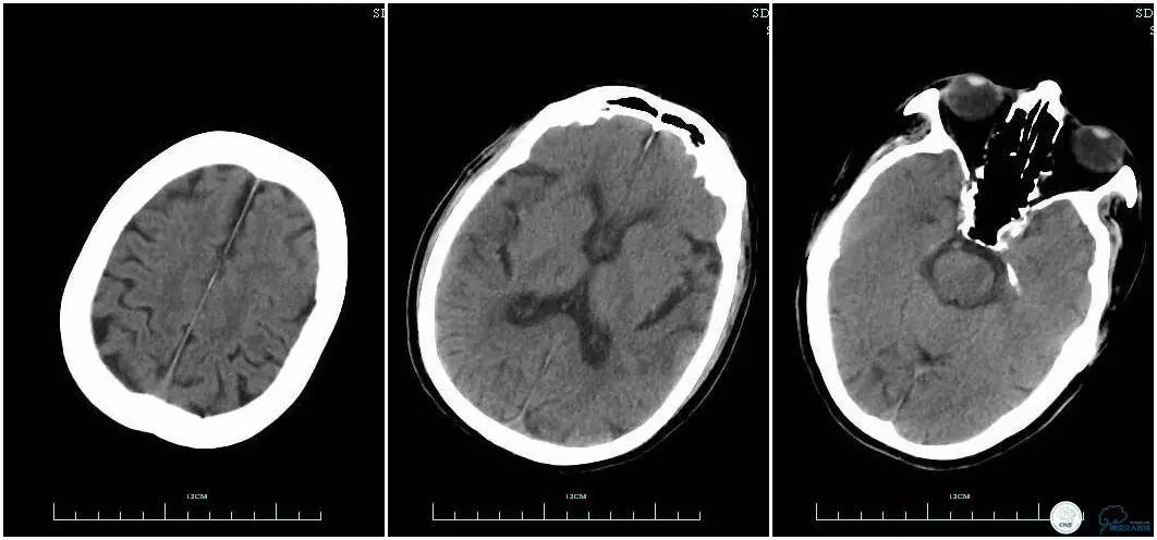 CINS2016病例展｜一例双侧大脑前动脉栓塞的再通治疗