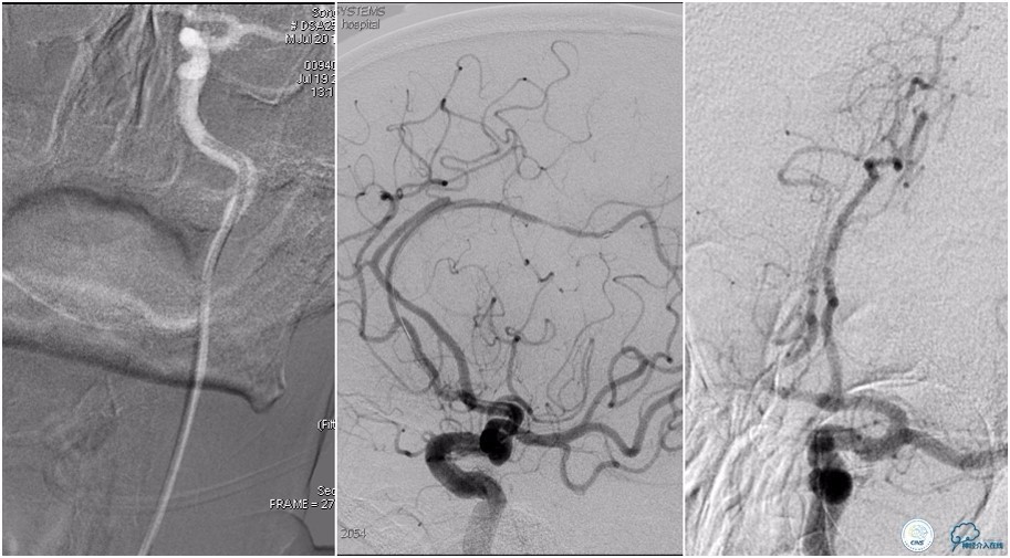 CINS2016病例展｜一例双侧大脑前动脉栓塞的再通治疗