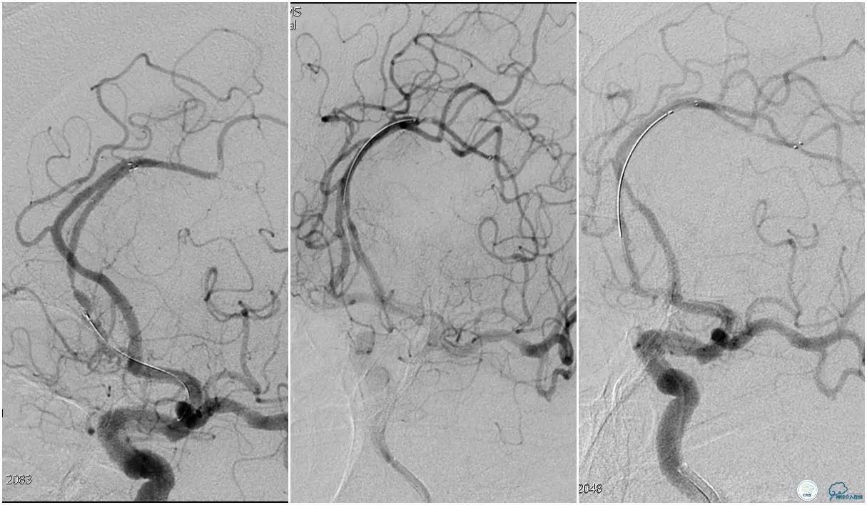CINS2016病例展｜一例双侧大脑前动脉栓塞的再通治疗