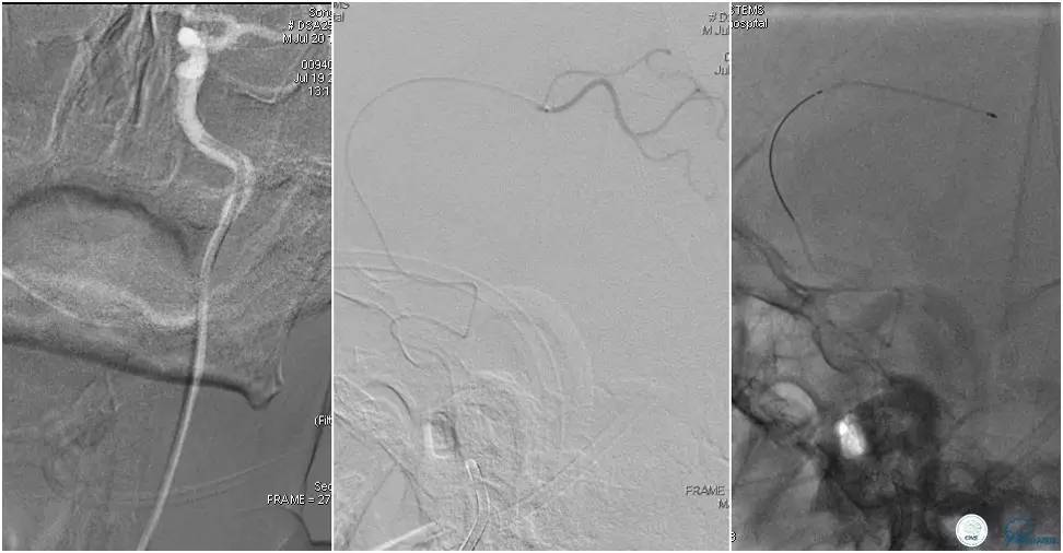 CINS2016病例展｜一例双侧大脑前动脉栓塞的再通治疗