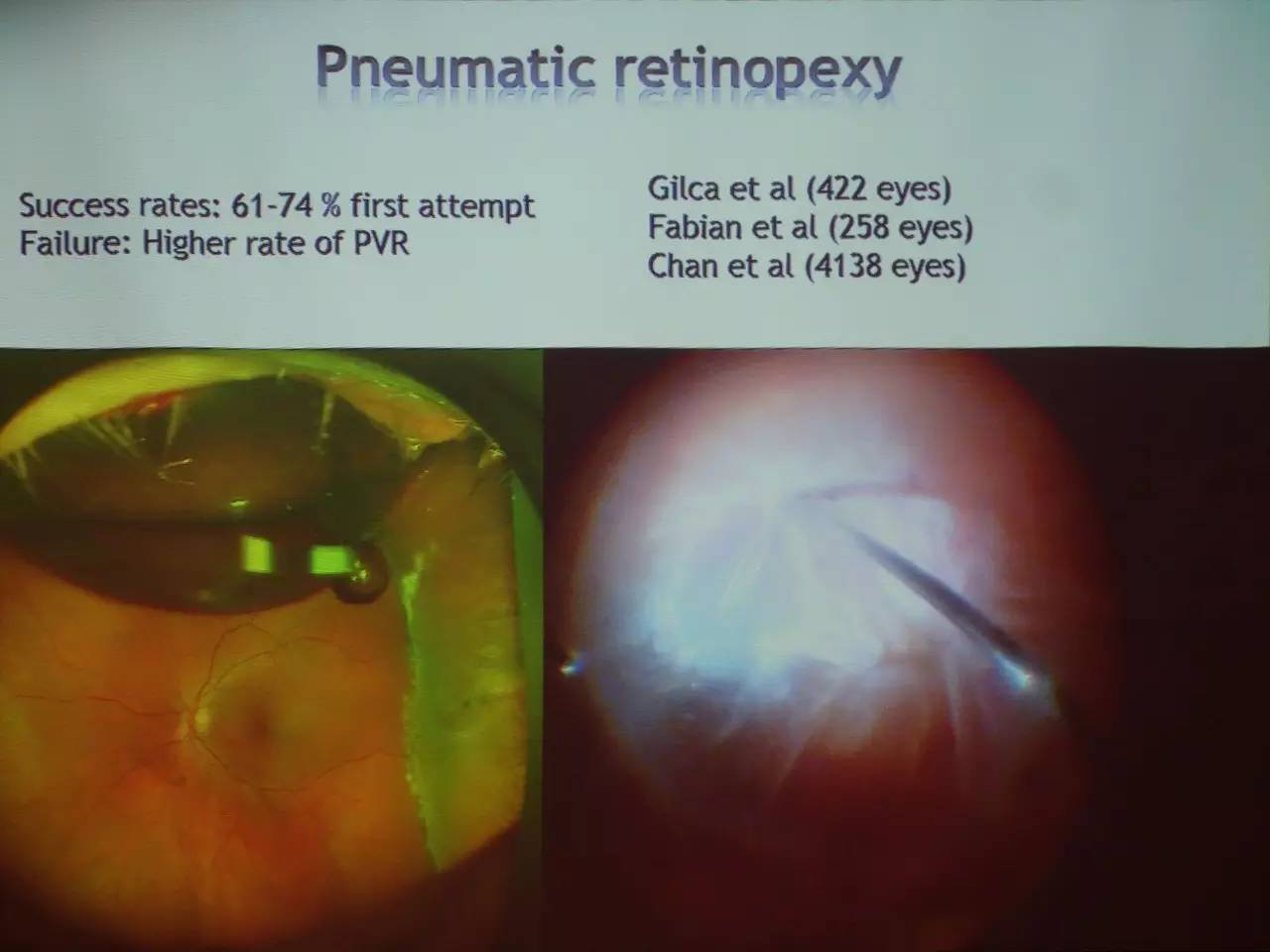 pvr眼科上是什么意思,pvr在眼底是什么病