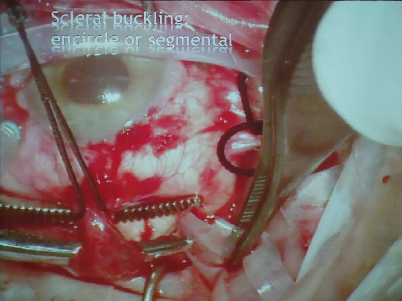 pvr眼科上是什么意思,pvr在眼底是什么病