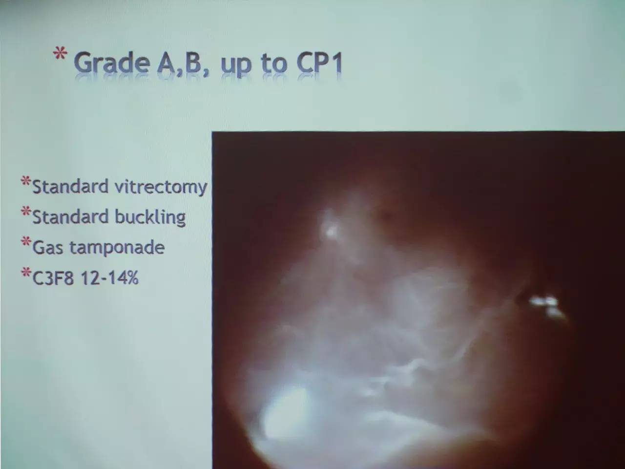 pvr眼科上是什么意思,pvr在眼底是什么病