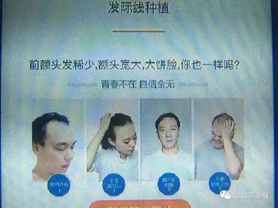 杭州年轻女子花了一万元做手术,女子花了100多万做头发