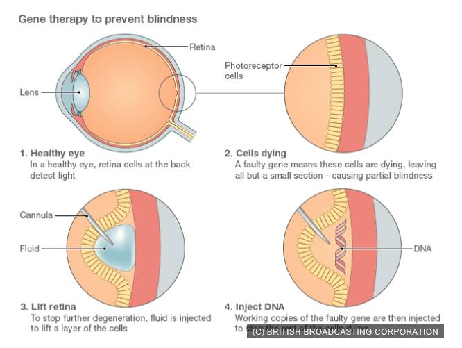 研发基因治疗药物NightstaRx要做无脉络膜症患者的光明使者