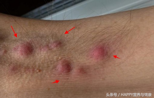 身上起了个包有臭味,身上起好多包是什么虫子