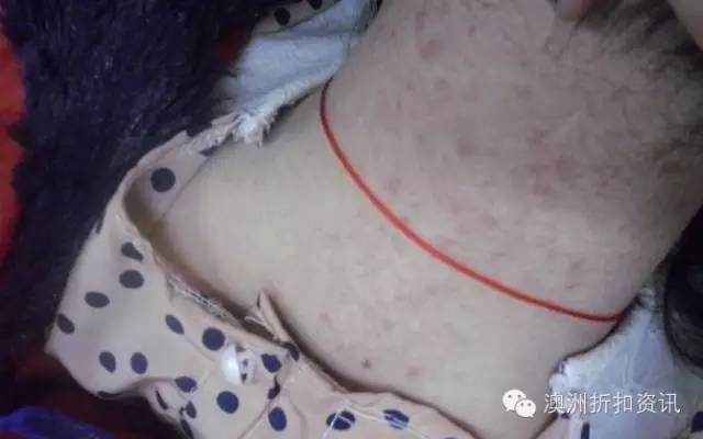 祛痘最强试用报告—Benzac强效祛痘系列