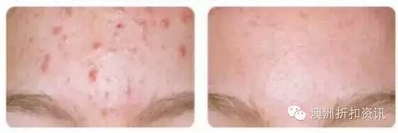 祛痘最强试用报告—Benzac强效祛痘系列