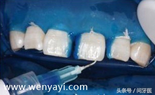 门牙有缝的女人有什么不好,门牙有缝怎么办