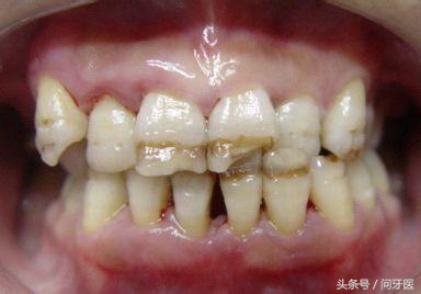 过年牙齿掉了一块,过年牙齿掉好不好