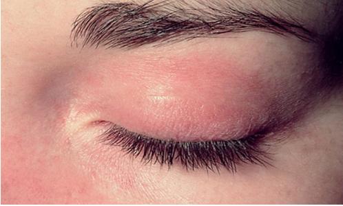 皮肌炎和多发性肌炎是什么样的疾病？