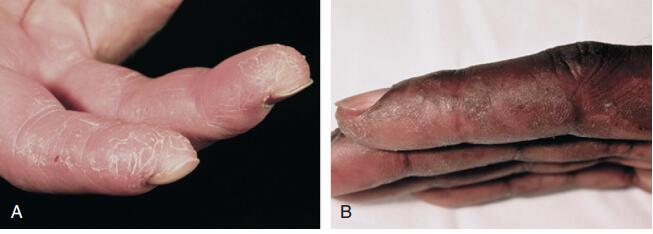 皮肌炎和多发性肌炎是什么样的疾病？