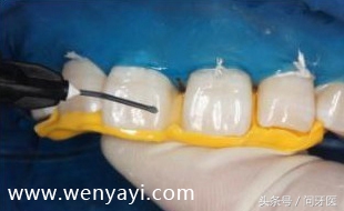 门牙有缝的女人有什么不好,门牙有缝怎么办