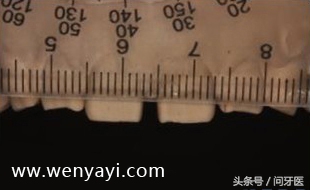 门牙有缝的女人有什么不好,门牙有缝怎么办