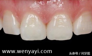 门牙有缝的女人有什么不好,门牙有缝怎么办