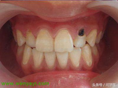牙齿烂了怎么办治疗多少钱,牙齿蛀烂全过程