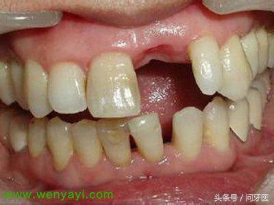 牙齿烂了怎么办治疗多少钱,牙齿蛀烂全过程