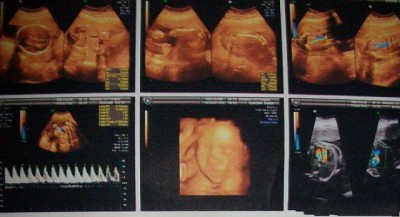 胎儿成长记录,胎儿1到10个月肚子变化