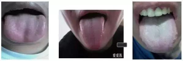 舌苔辨证图谱望舌识病,揭秘舌苔图谱轻松自诊