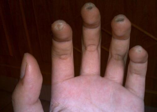 如何练吉他左手不会起茧,练吉他手指起茧会难看吗