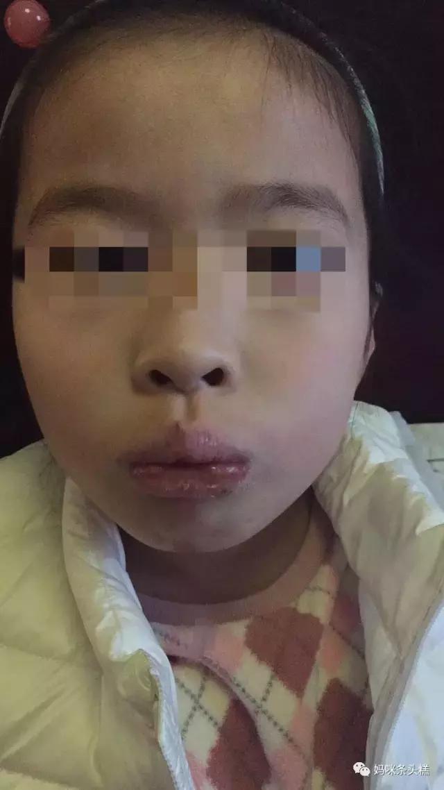 疱疹性咽峡炎亲身经历,儿童疱疹性咽峡炎记录