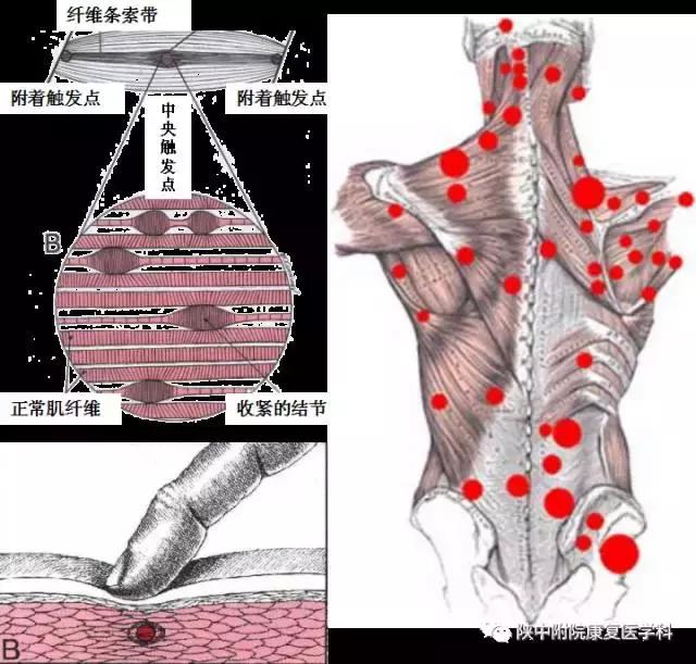 扎针治疗疼痛的原理,治疗疼痛最好的针法