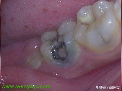 牙齿烂了怎么办治疗多少钱,牙齿蛀烂全过程