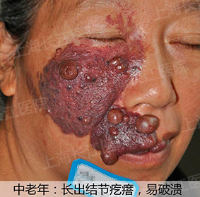 为什么红胎记会突出皮肤表面,光动力治红胎记失败