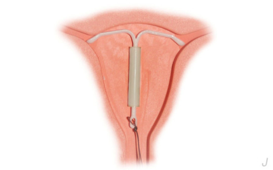 女性上环痛还是取环痛,关于上环取环你应该了解这些