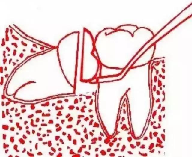 智齿的治疗过程,智齿要上下成对拔除吗
