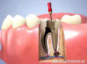 说清楚到底是什么意思,有几种原因引起牙疼