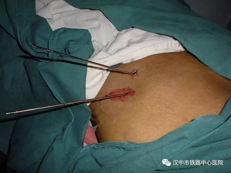 骨盆髋臼骨折内固定手术,骨盆骨折空心螺钉固定器械