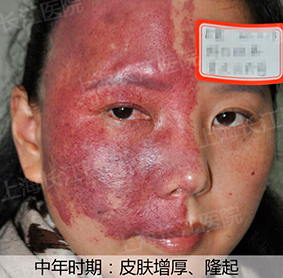 为什么红胎记会突出皮肤表面,光动力治红胎记失败