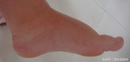 心血管堵塞身体会出现什么症状,冠心病血管堵塞90%是什么症状