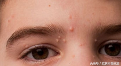 小孩传染性软疣冷冻后变成了水泡,儿童常见皮肤病疣